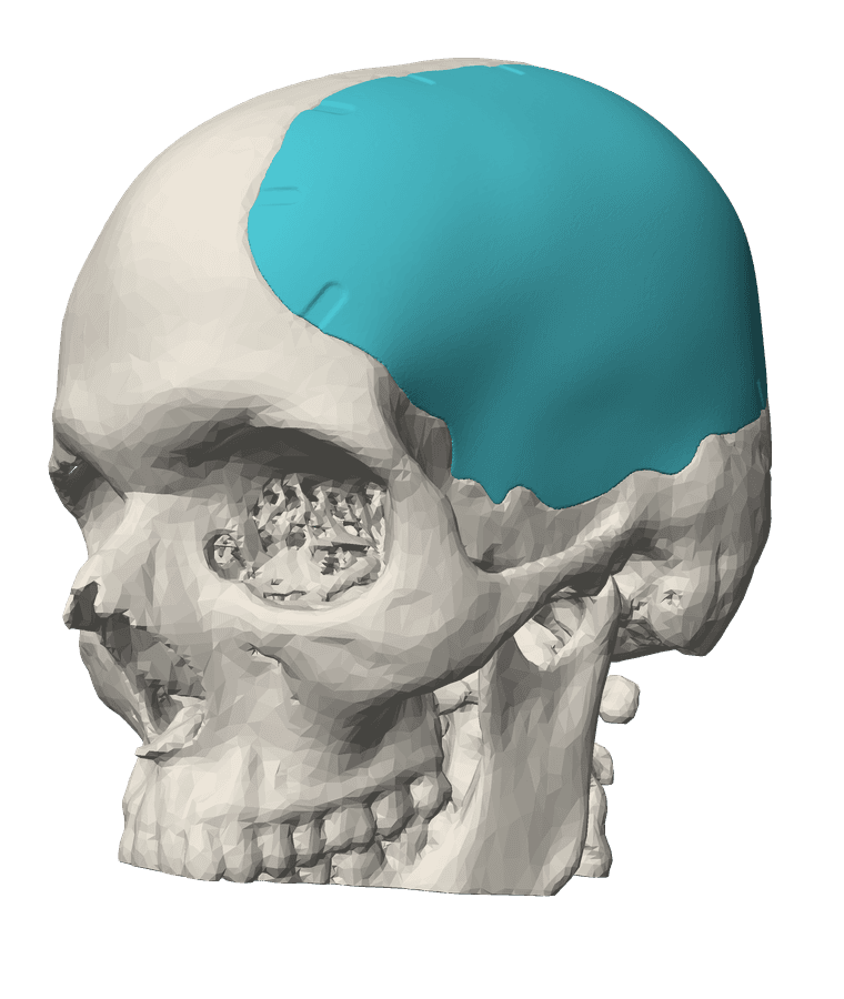Implant crânien sur mesure en PEEK — COVTECH MEDICAL