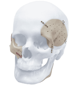 Implant cranio-maxillo-facial